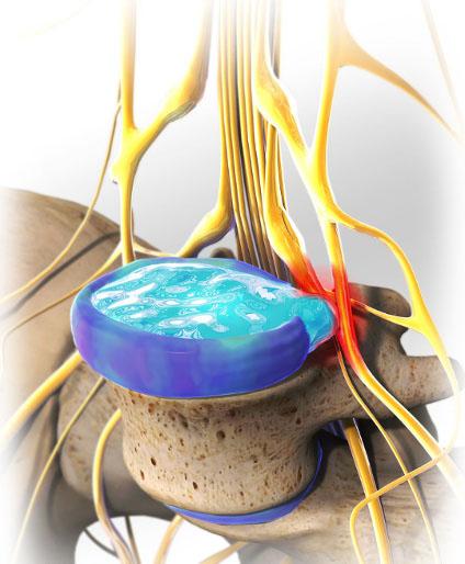腰椎间盘突出能够完全治好吗,腰椎间盘突出能够治疗吗