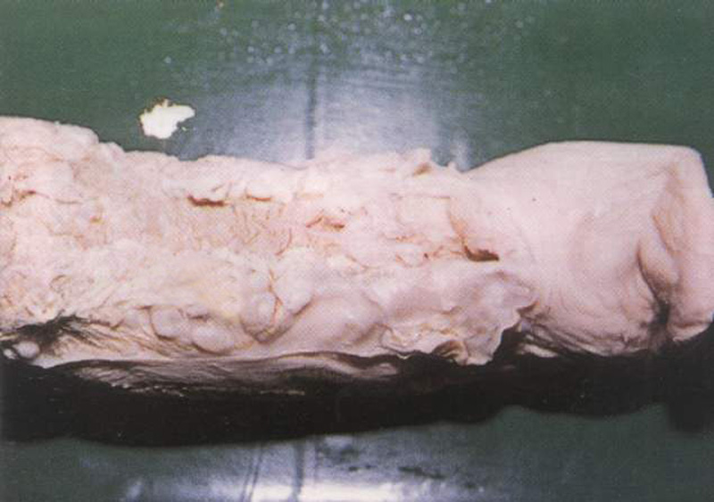 人感染猪囊虫病怎么办,人畜共患寄生虫病中的动物是什么