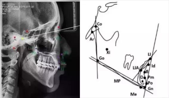 正畸最常用的头影测量法,口腔正畸学入门必学之头影测量