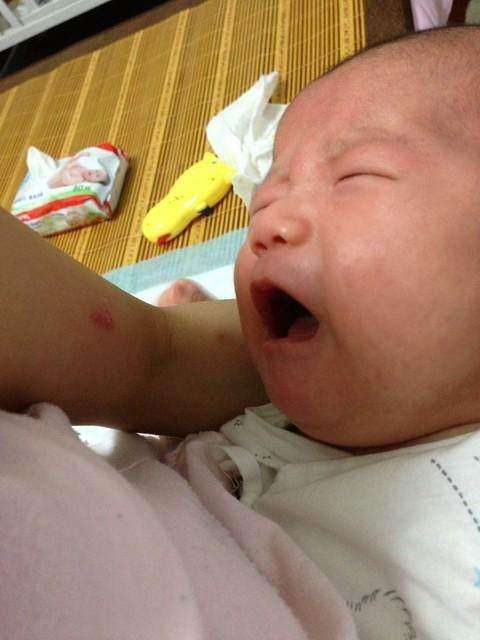 婴儿头上的湿疹用什么药呢,婴儿头上湿疹渗液揭开怎么处理