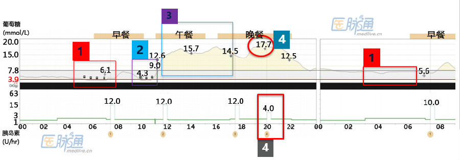 胰岛素泵动态监测血糖,泉信济南