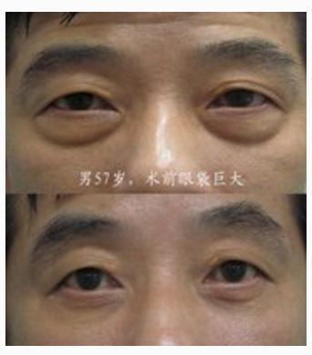 切除眼袋是唯一解决眼袋的方法,眼袋切除方法有哪些