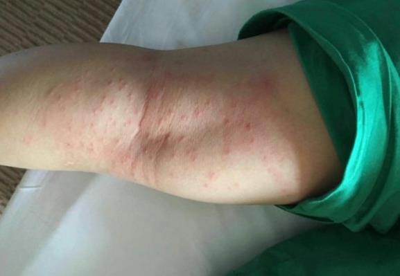 宝宝身上有螨虫包应该擦什么药,小孩身上有螨虫痒比较严重怎么治