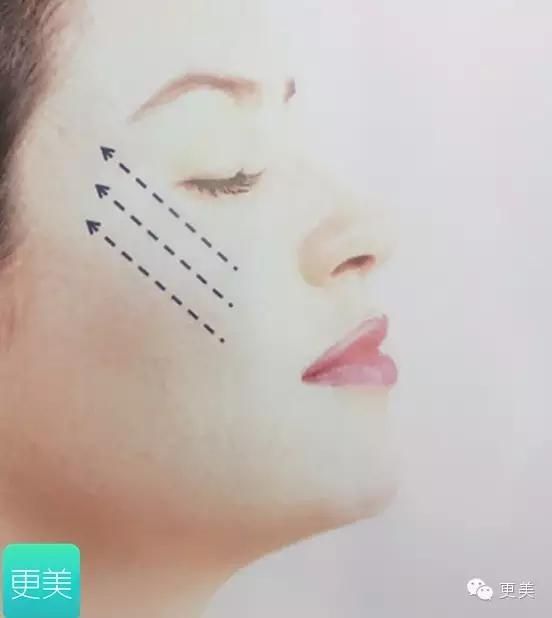 埋线美容线和不吸收线有什么区别,医院埋线和美容院埋线有什么差别