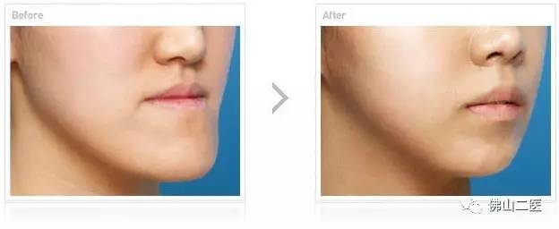 「医生说」“地包天”不容忽视口腔正畸专家提醒，越早接受治疗效果越好