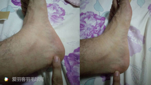 脚疼的15种原因和治疗方法,脚疼怎么才能彻底根治