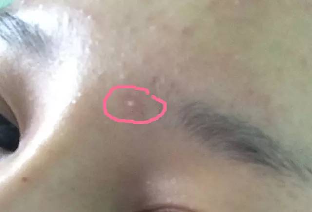 十年战痘血泪史详解,战痘知识分享