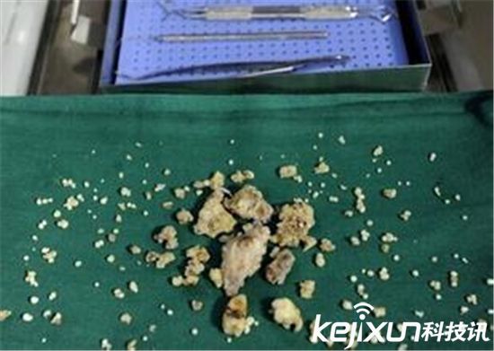 男孩嘴里有526颗牙,男孩多牙症300颗牙齿