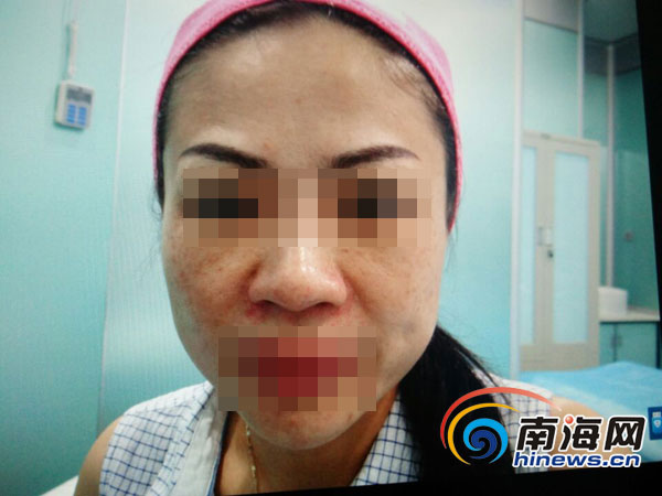 囧！海口女子到美容院做祛斑8个月后*褐斑黄**更多