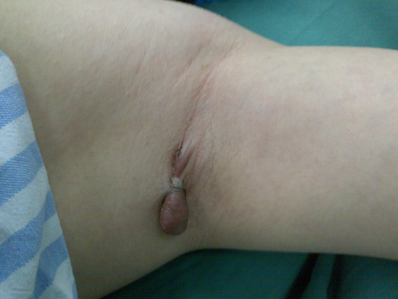 10年的手术疤痕,十年的手术疤痕