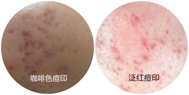 战痘合集完整版,战痘大结局完整版