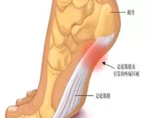 丁丁谈跑步｜受伤了还能不能跑？——常见运动损伤的处理方法
