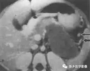 18种疾病包括哪些,18种肿瘤有哪些