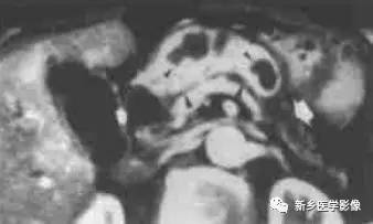 18种疾病包括哪些,18种肿瘤有哪些