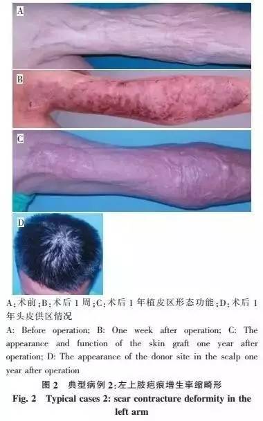 以头皮为供区的大张中厚皮片在创面修复中的应用