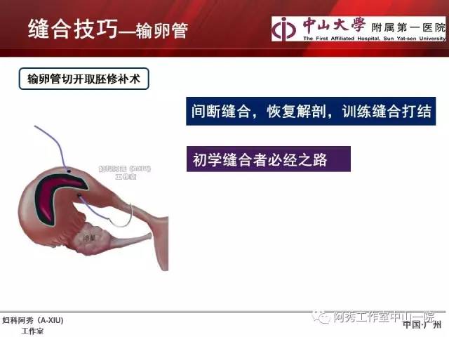 妇科腹腔镜下常用缝合技巧
