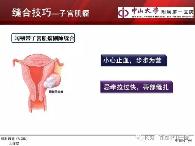 妇科腹腔镜下常用缝合技巧