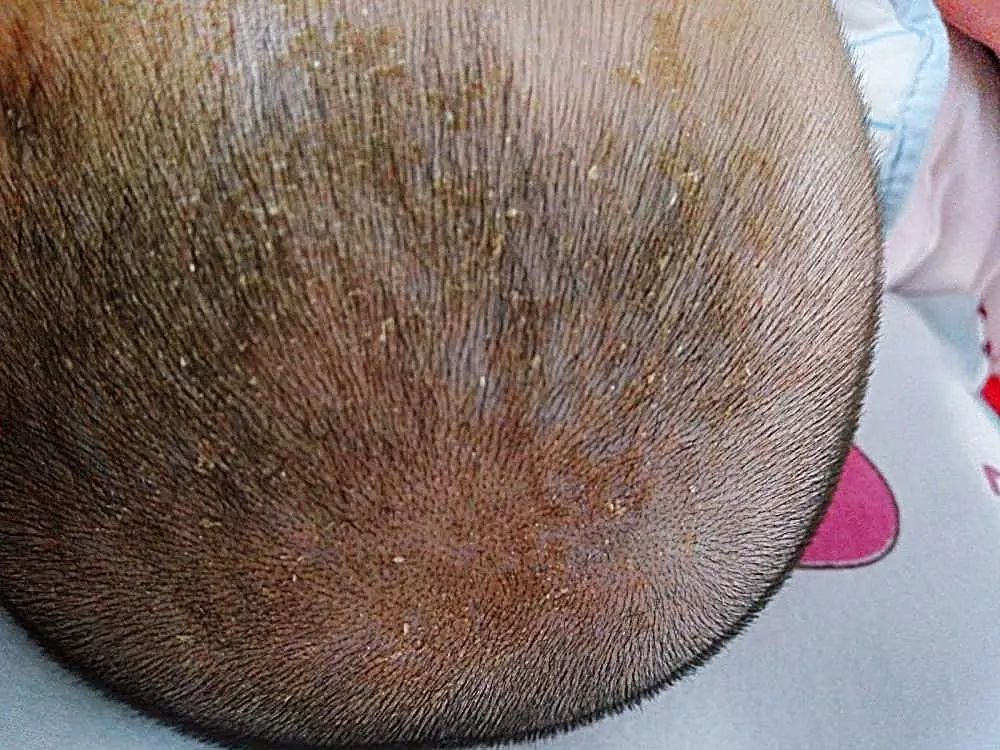 4个月宝宝头皮乳痂反复起怎么办,婴儿头皮乳痂什么时候清理比较好
