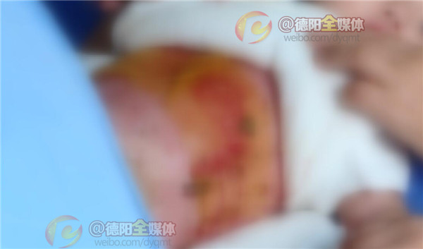 19岁烧伤女孩小玲出院啦,烧伤女孩小玲最新消息