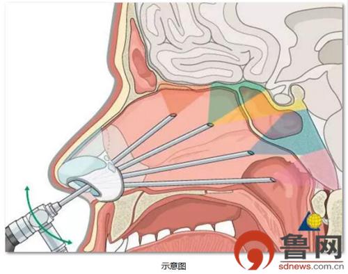 青岛齐鲁医院神经外科住院部,齐鲁医院青岛院区神经内科