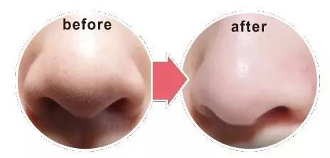 黑头反反复复去不掉,黑头老是反复怎么去解决