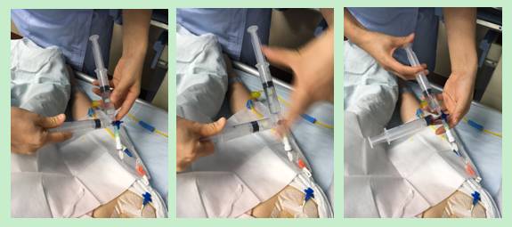 CVC堵管使用负压抽吸,轻轻松松搞定