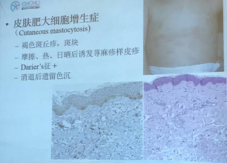 幼儿麻疹的鉴别方法,儿童麻疹的诊断与治疗