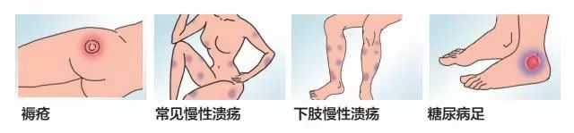 身上伤口不易愈合是怎么回事,身体后面有伤口一直不愈合