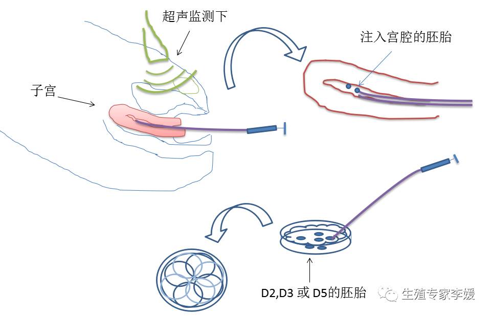胚胎移植后必须用阿司匹林吗,胚胎移植后有必要吃药吗