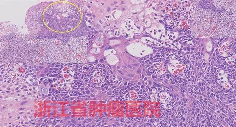 食管大面积黏膜病变,看看这家医院如何处理?!