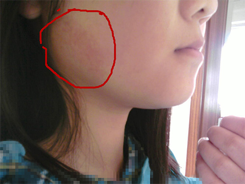 冬季吹空调脸上干燥泛红怎么办,夏天吹空调脸部发红脱皮怎么办