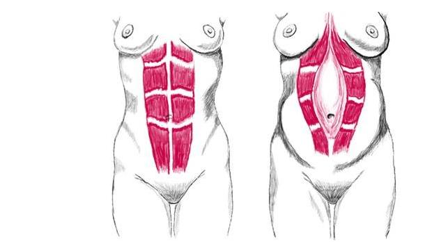 产后背疼怎么锻炼恢复,产后康复训练之背部肌肉训练