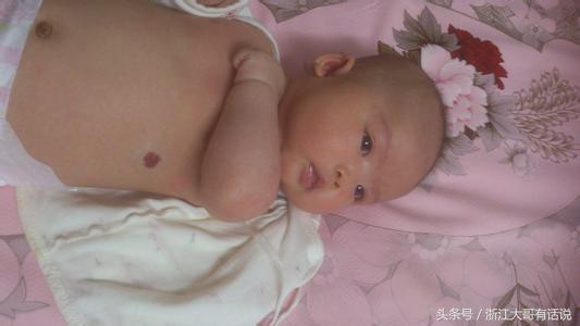 宝宝胎记为何“同记不同命”是因为你陷入了这几个误区