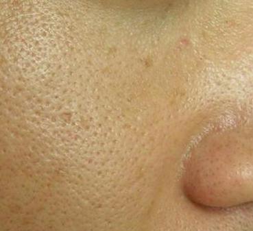 如何修复毛孔粗大和痘坑,痘坑痘印毛孔粗大的区别