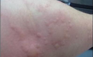荨麻疹是怎么样兴起的,荨麻疹怎么治疗