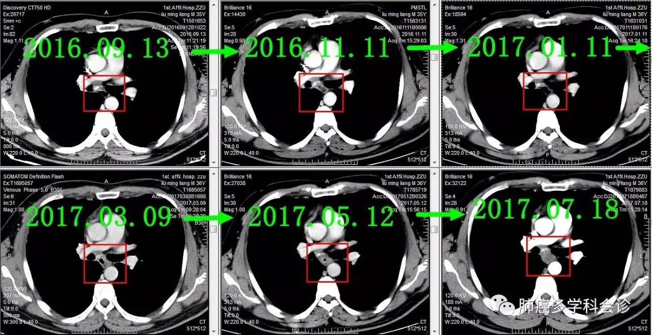 食管癌转移两侧淋巴癌严重吗,食管癌转移和扩散区别