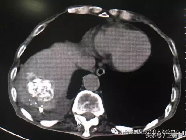 近日运城市第一医院肿瘤微创及介入治疗中心行肝癌破裂急诊行介入栓塞治疗术后患者出血停止腹痛减轻
