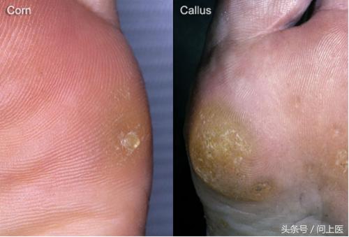 你的脚部是否有这4个特征,脚部反射图及疾病大图解