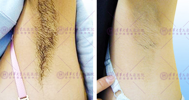 激光夏天做还是冬天做比较好,激光夏天做好还是冬天做好