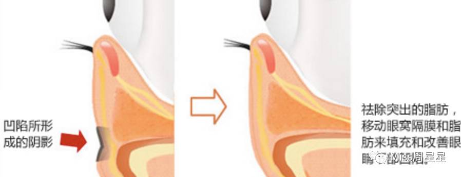 千年黑眼圈解决方案,万年黑眼圈有救的吗