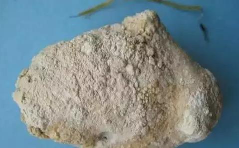 治疗胆结石的最新最好的方法,中医治疗胆囊炎胆结石的方法