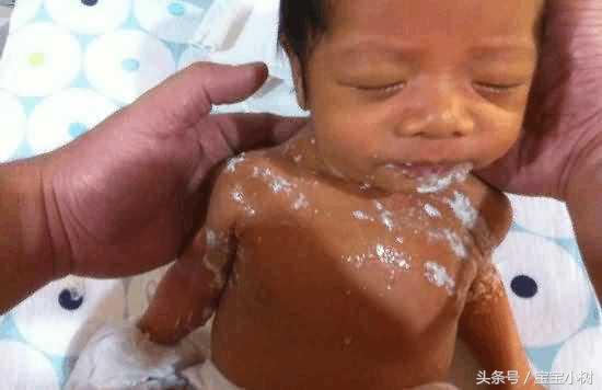 吐奶和幽门狭窄的区别,宝宝幽门狭窄导致吐奶咋治疗