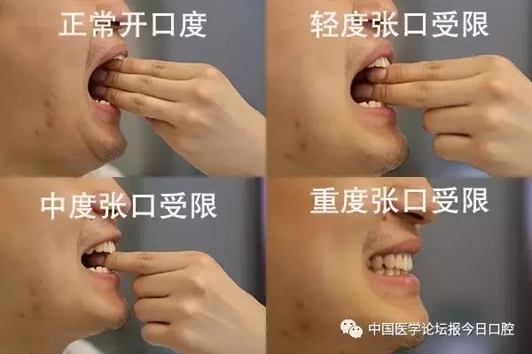 拔完智齿脸肿嘴张不开怎么拆线,拔智齿的时候脸肿了多久能恢复