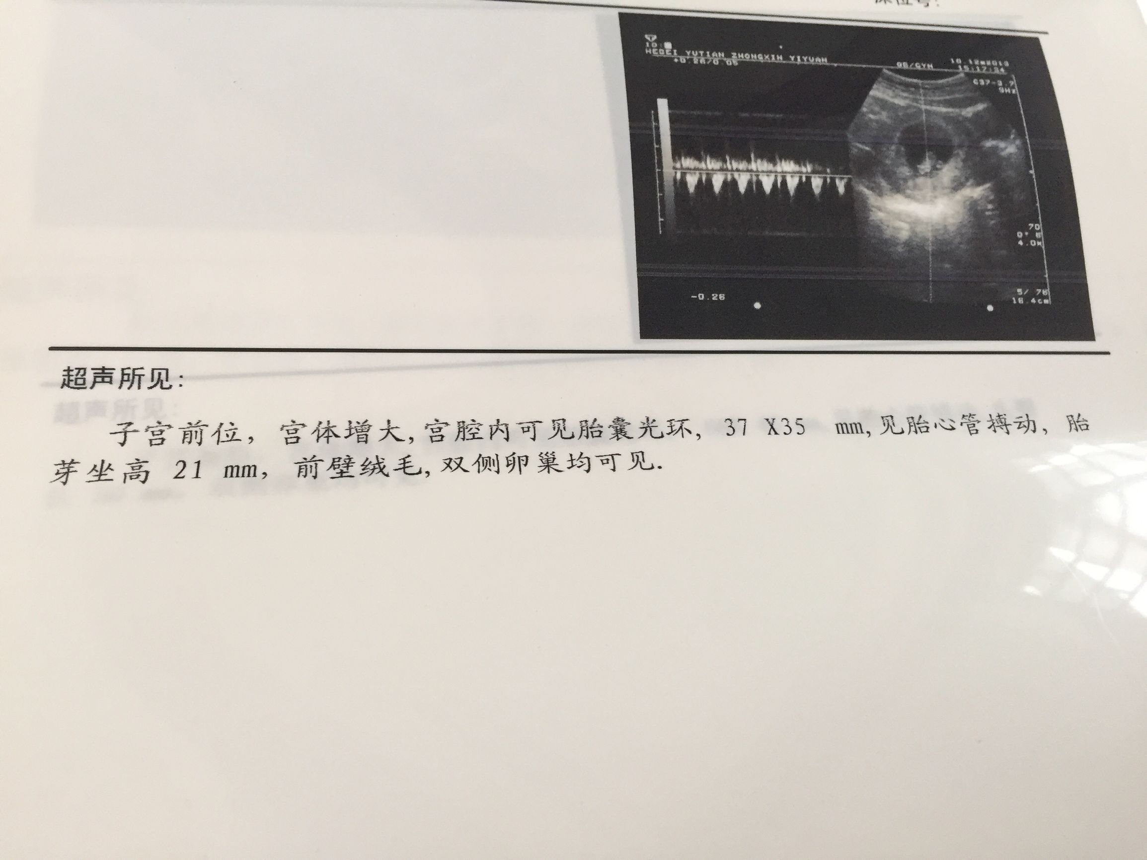 怀孕后第一次b超什么时候去做,怀孕后第一次b超应该什么时候做