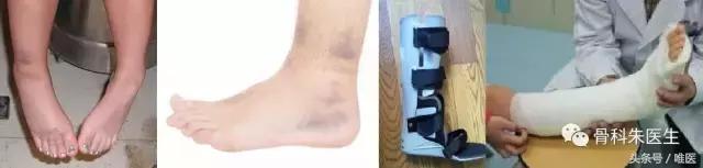 踝关节骨折没有手术怎么办,骨折保守治疗可以活动踝关节吗