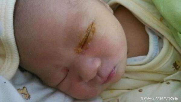 新生宝宝眼屎多眼睛肿了咋回事,新生宝宝眼屎黄脓状怎么办