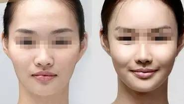 娱乐圈不老男神的秘诀,明星们的冻龄秘诀玻尿酸