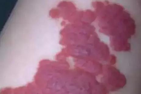 宝宝身上有5个胎记,孩子身上有10块胎记