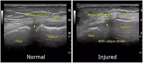 膝关节内侧副韧带损伤如何治疗,膝关节内侧副韧带损伤如何恢复