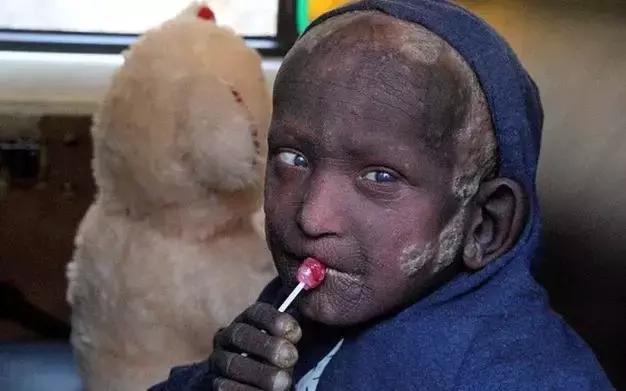 印度男孩身上长满了什么,印度11岁男孩长满鳞片